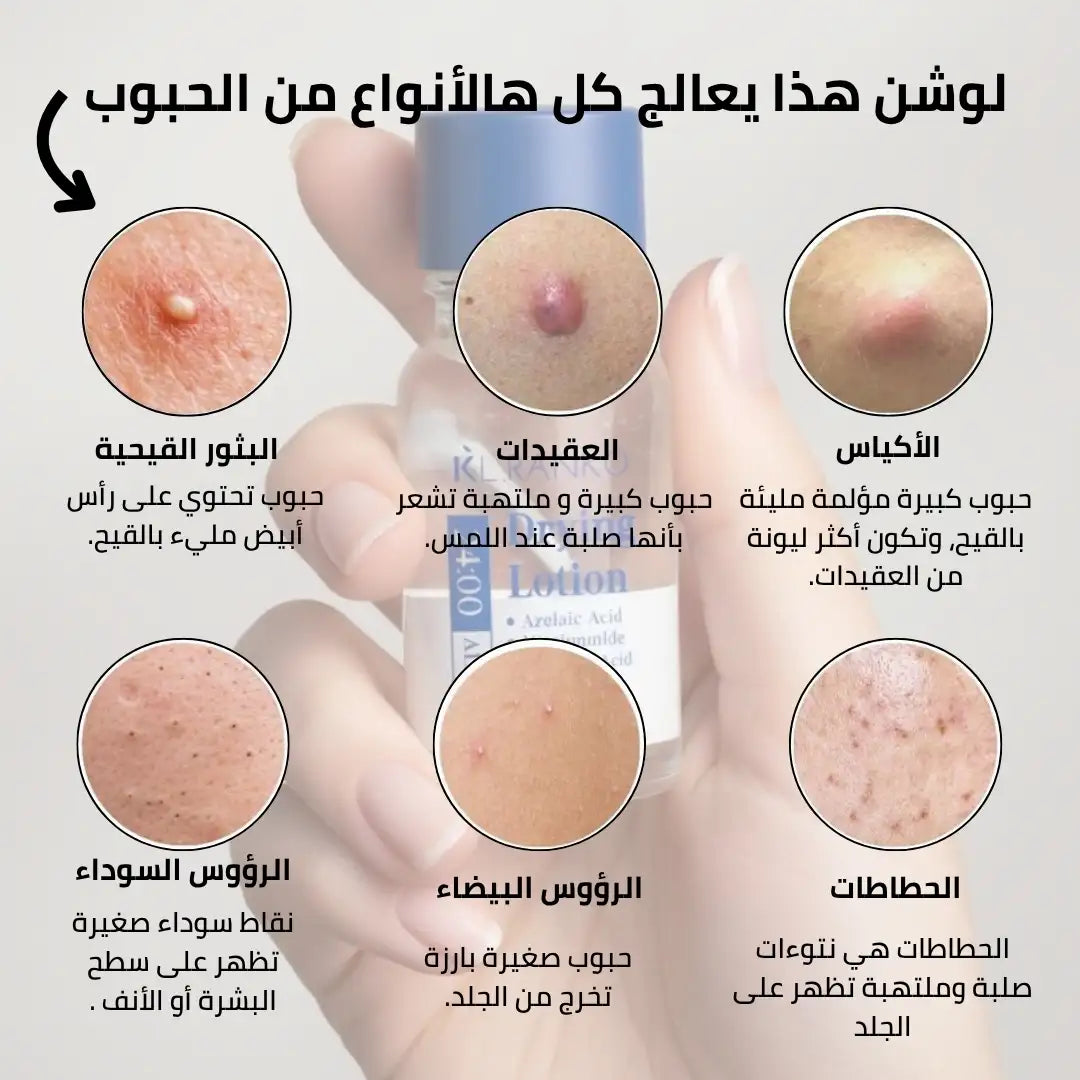 لوشن علاج حب الشباب بحمض الساليسيليك