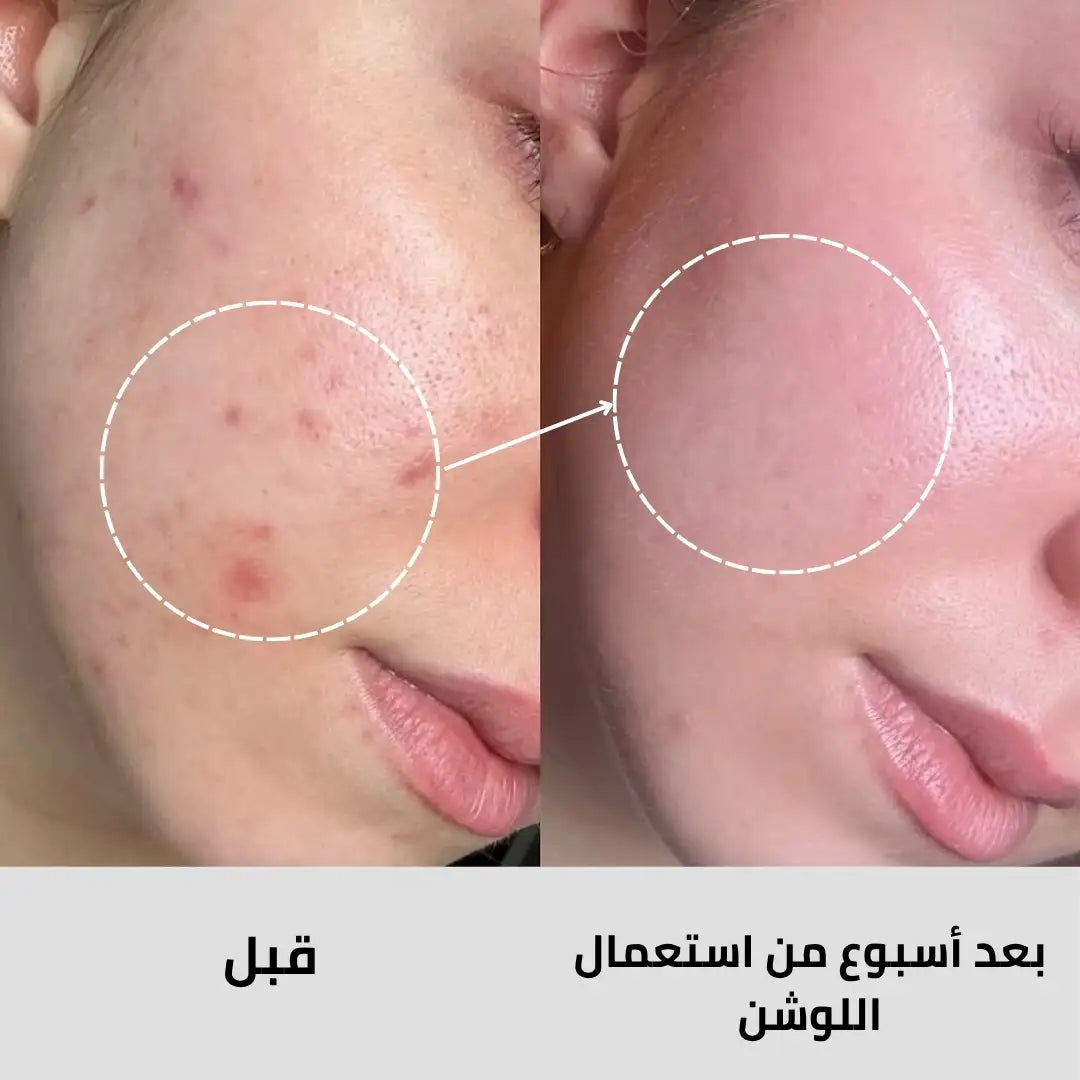 لوشن علاج حب الشباب بحمض الساليسيليك