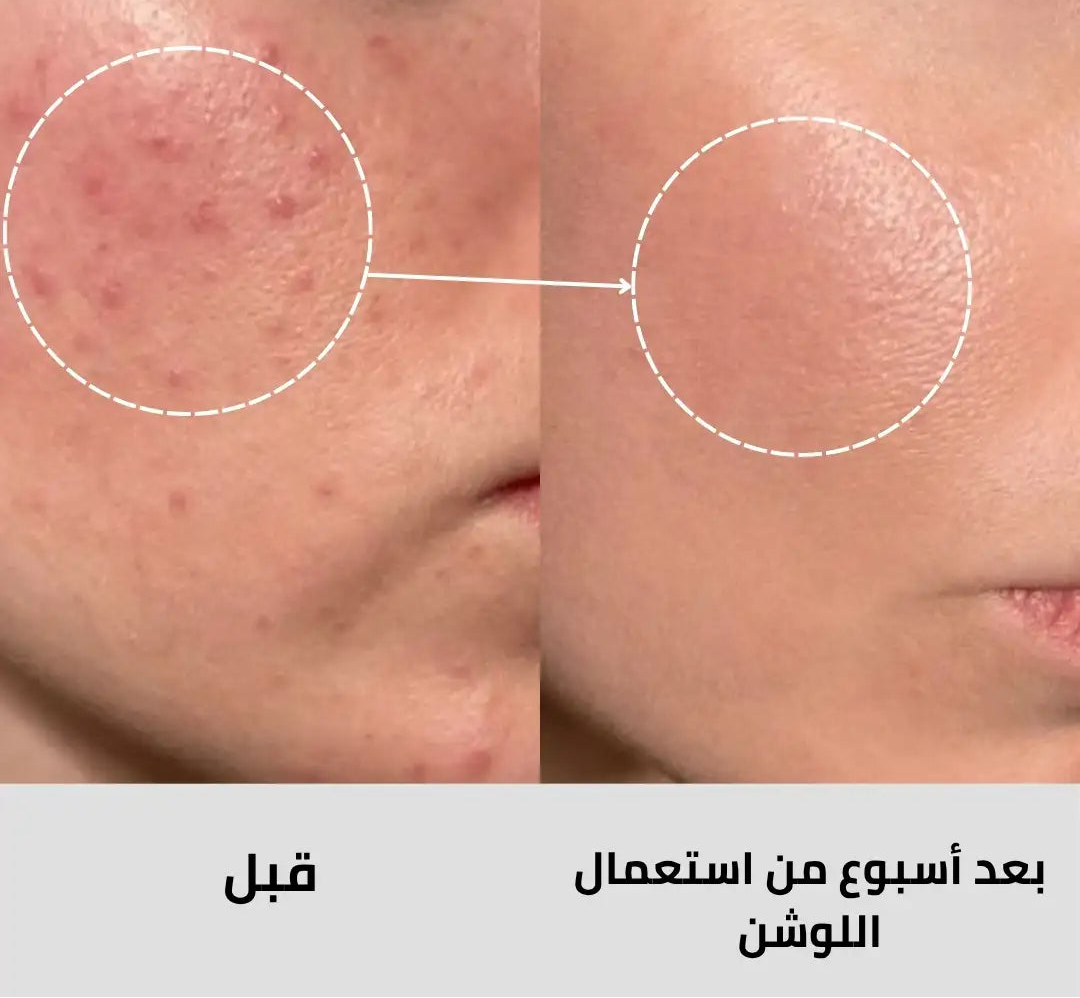 لوشن علاج حب الشباب بحمض الساليسيليك