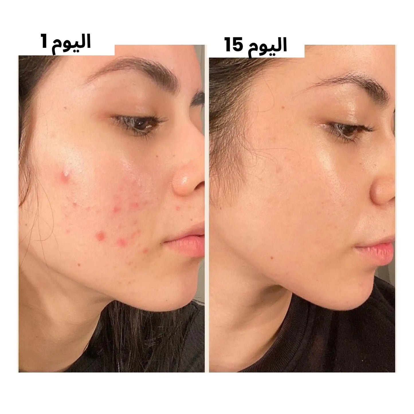 احصلي على بشرة صافية في أسبوعين حتى لو كان وجهك فيه حبوب