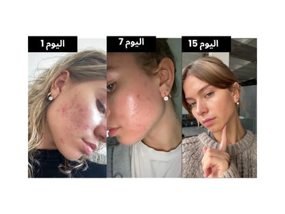 5 أنواع قوية من السيراميد تستهدف حاجز البشرة المدمر